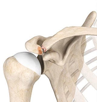 weightlifters shoulder injury human anatomy