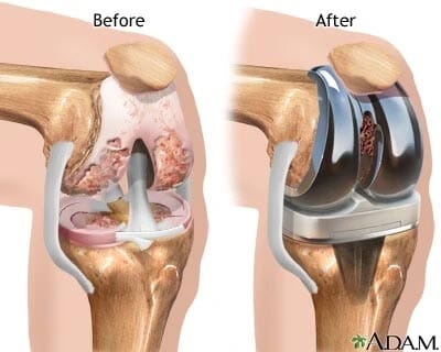 Medical Diagram of a before and after total knee replacement