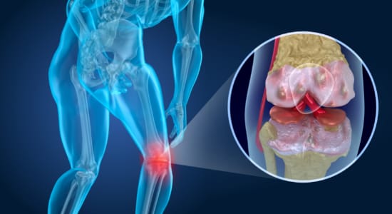 Knee Arthritis from too much exercise