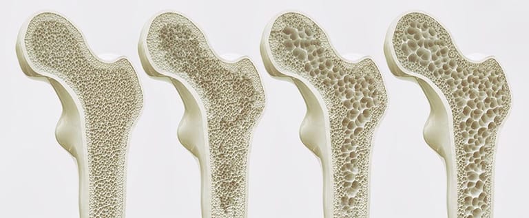 Osteoporosis Stages - 4 Stages of Bone Density Loss