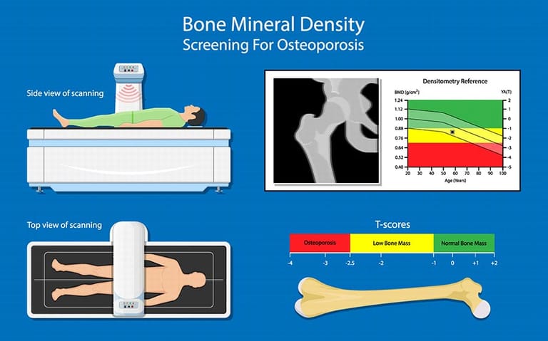 Dexa Scan for Osteoporosis Infographic