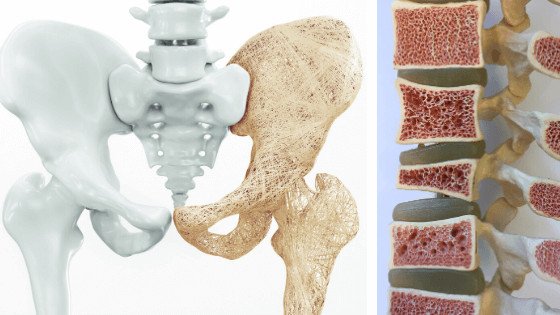 What is Osteoporosis