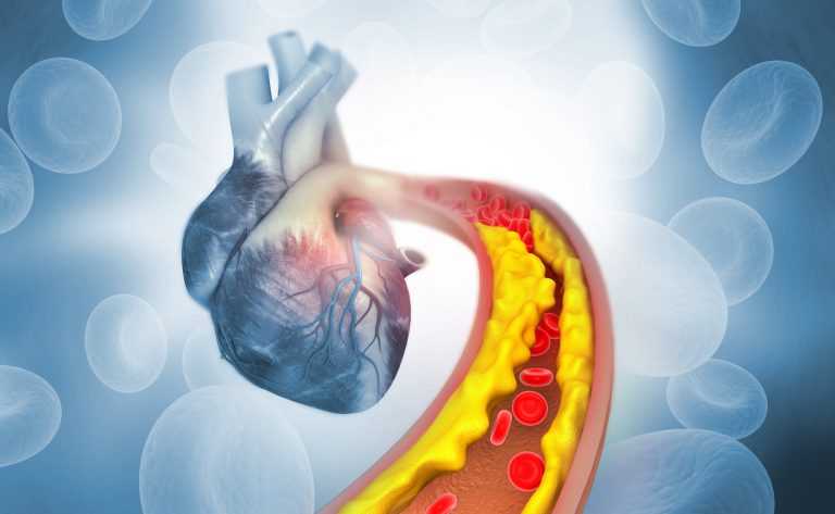 plaque in artery headed to heart