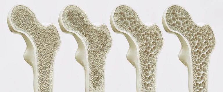 Osteoporosis Stages - 4 Stages of Bone Density Loss