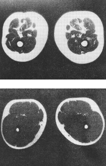 sarcopenia medical images