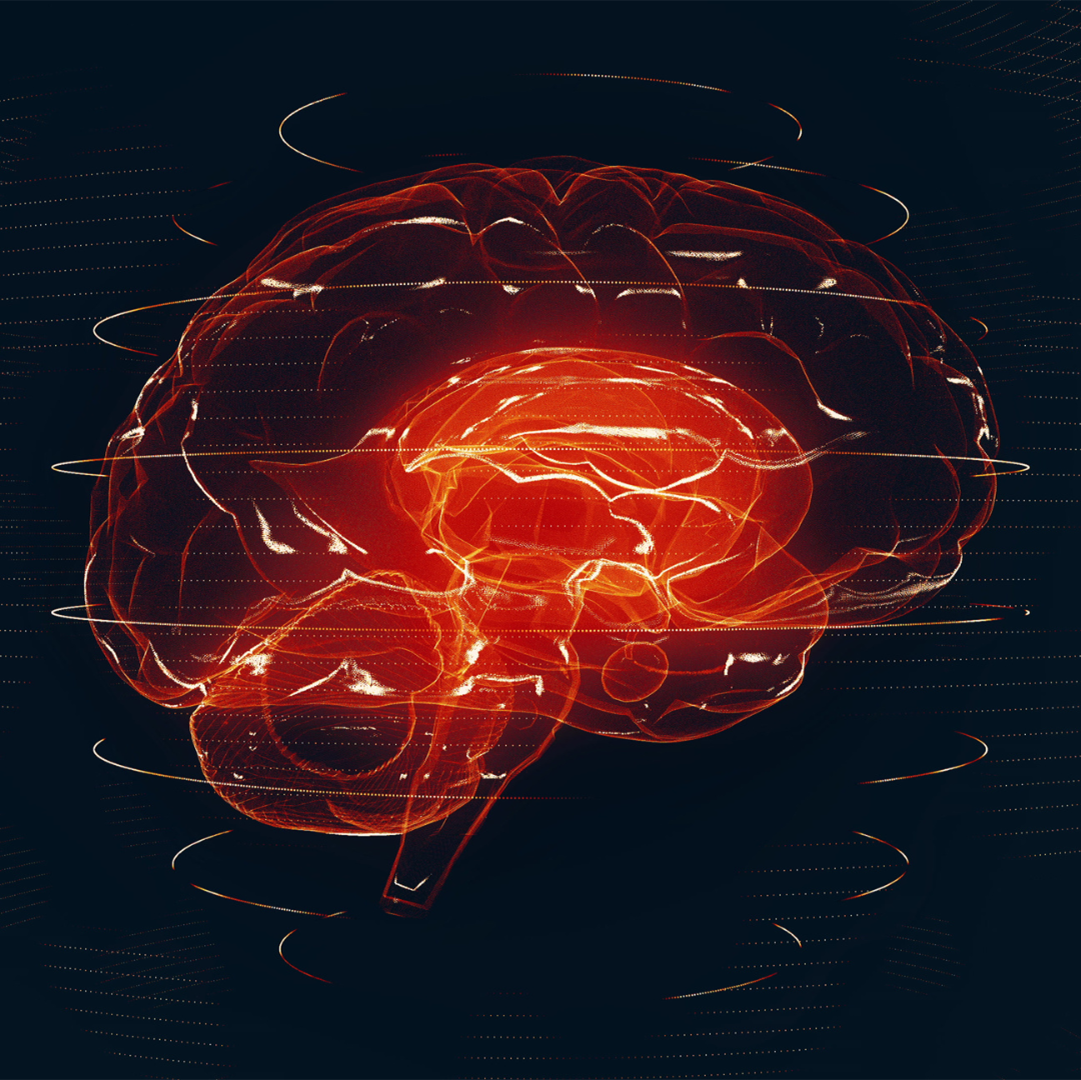 A Hopeful Approach to Slowing Parkinson’s Progression: The Potent Effect of Resistance Training on This Disease