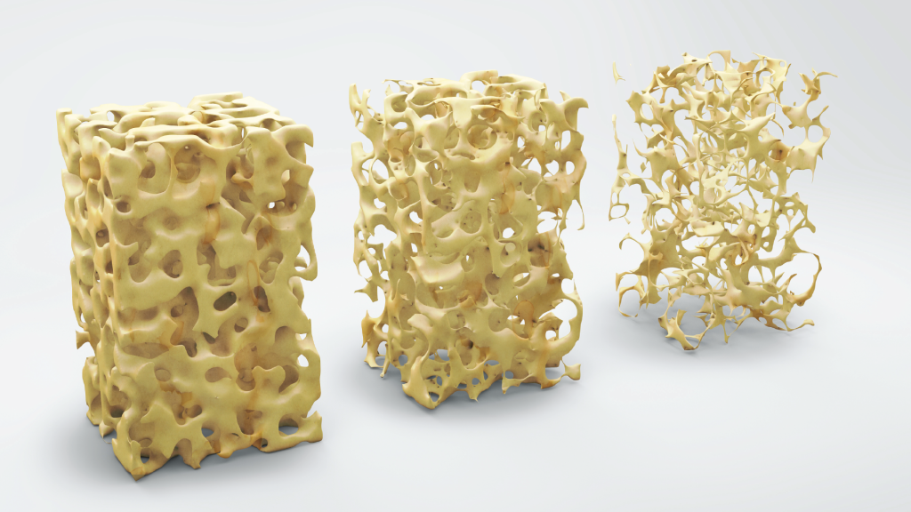 What your bones look like with Osteoporosis and Osteopenia