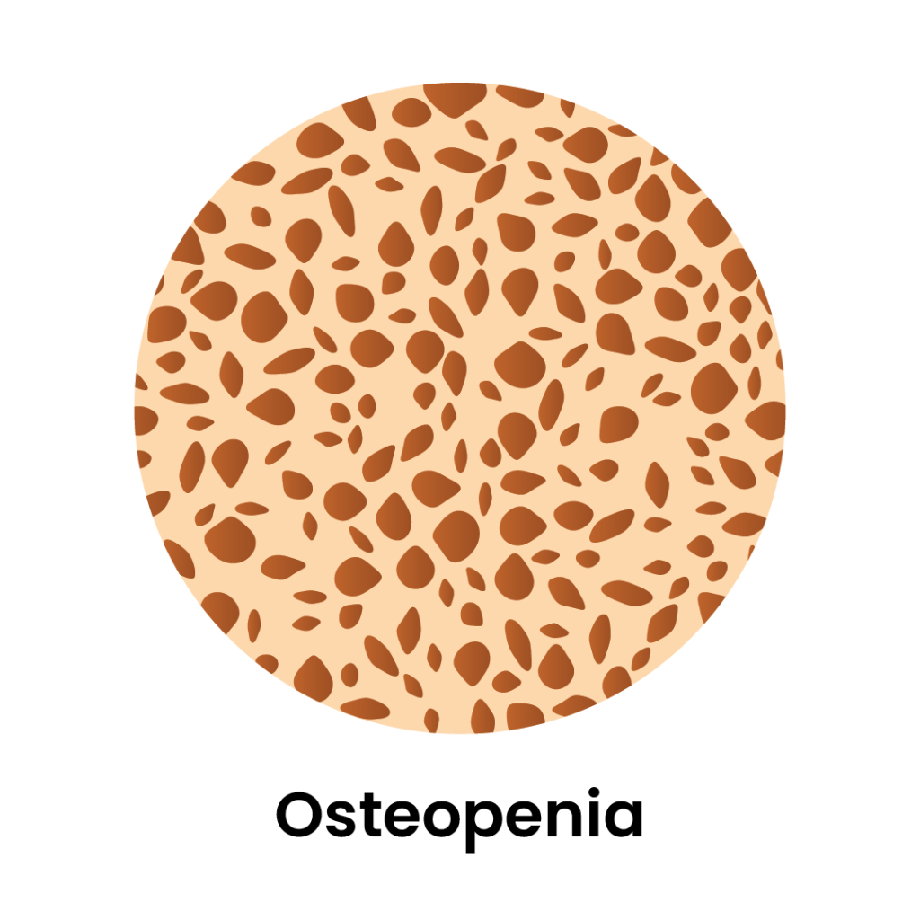 Image of what Osteopenia looks like in bones