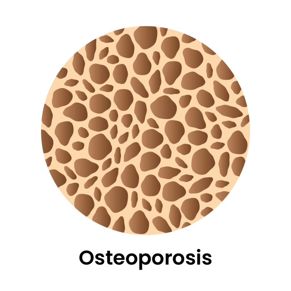 Image of what Osteoporosis looks like in bones