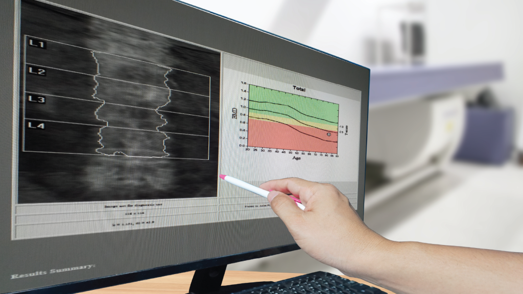 Dexa can results for osteoporosis