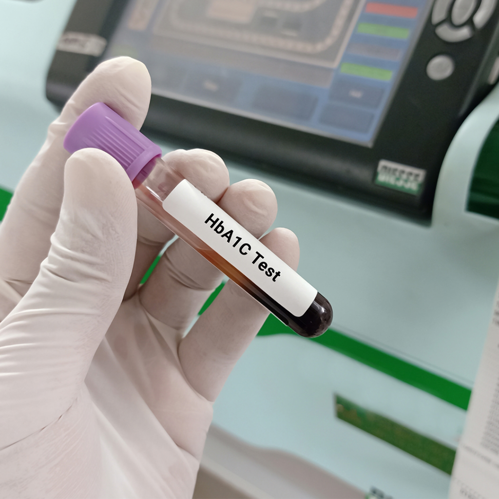 HbA1C test for Diabetes